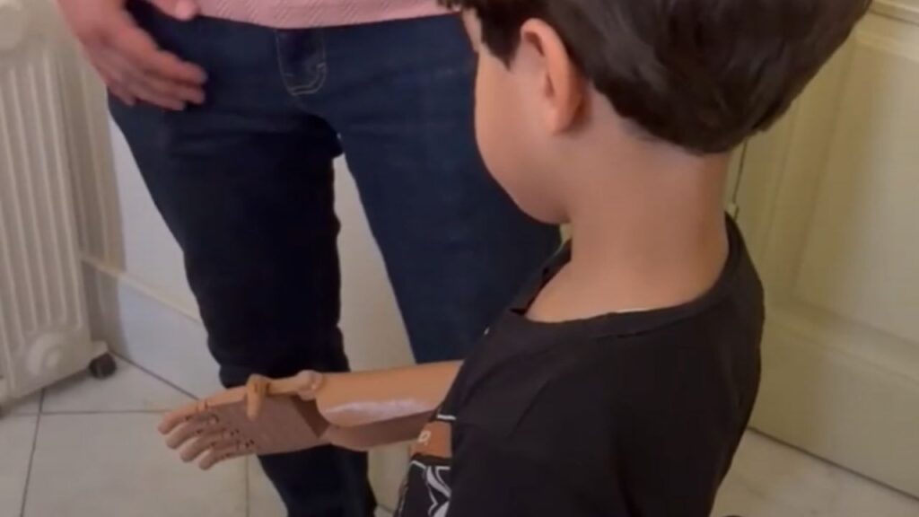 Omar y la primera prótesis 3D que rompe el bloqueo en la Franja de Gaza